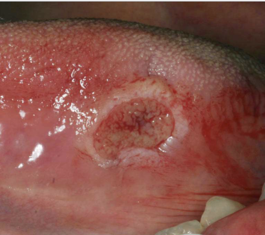 <p>penetrating ulcer that takes weeks-months to resolve&nbsp;</p>