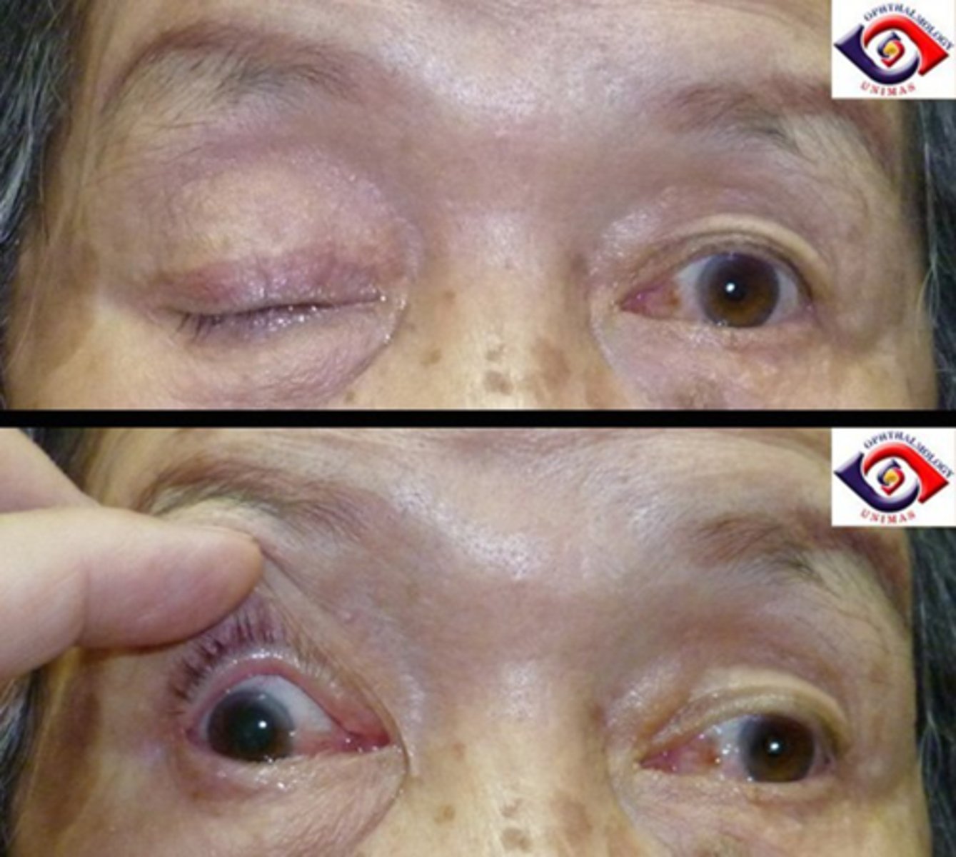 <p>CN 3 palsy (parasymp issue) will show...</p><p>ptotis</p><p>eye is "down and out"</p><p>large pupil</p>