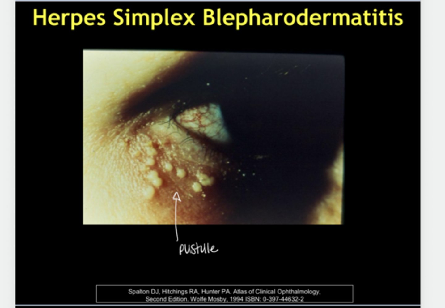 <p>What is Herpes Simplex Blepharodermatitis?</p>