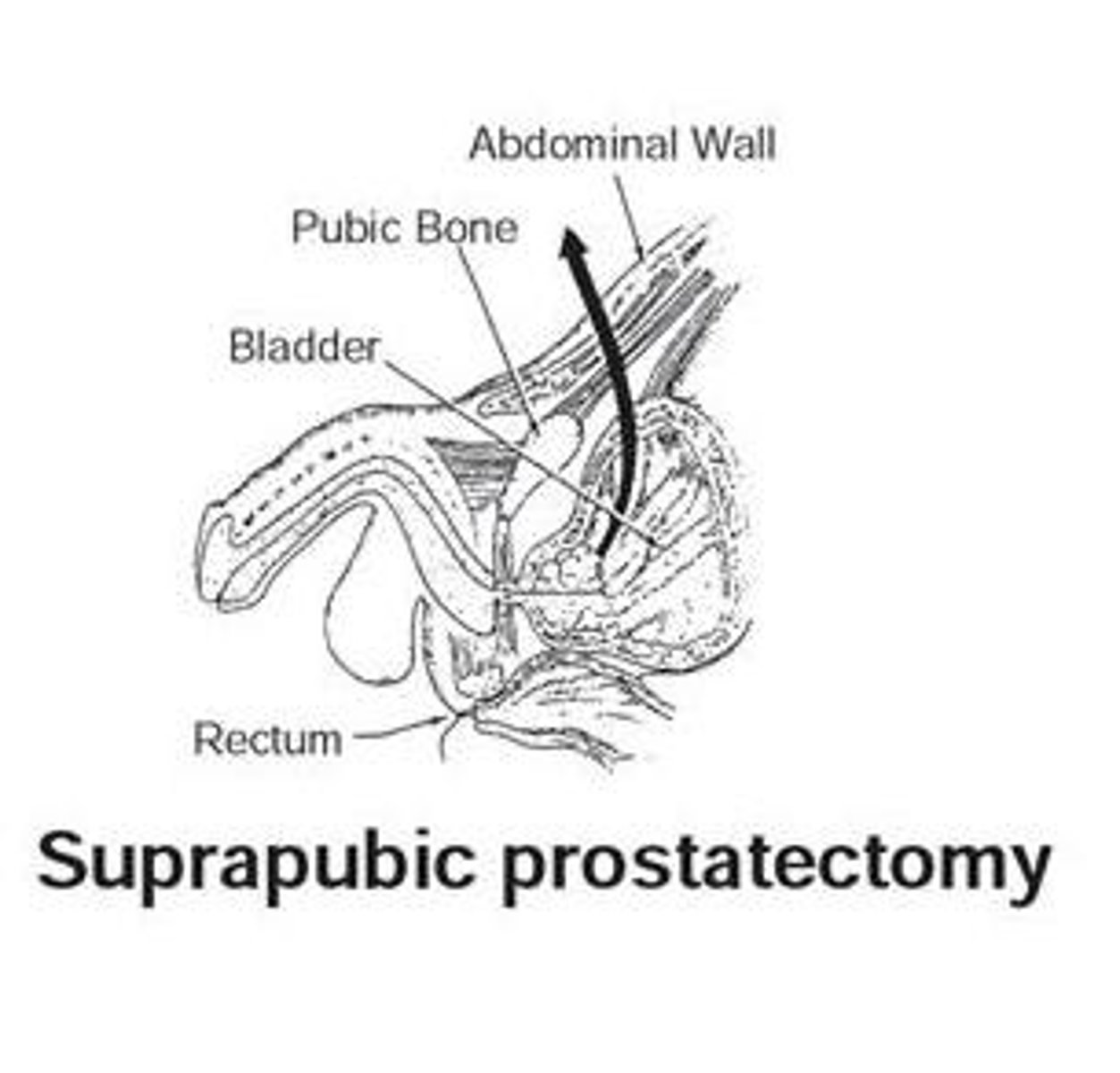 <p>removal of the prostate gland via incision into the abdomen above the pubic bone of the pelvis</p><p>- form of endoscopic surgery. This procedure is used to tx early states of prostate cancer, especially for men younger than age 70</p>