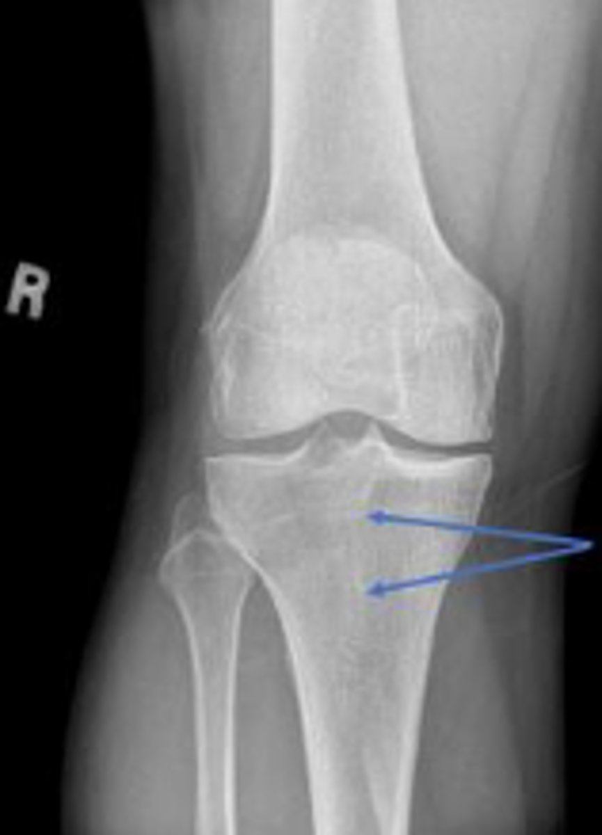 <p>What area of the tibia is pointed to by the arrows?</p>