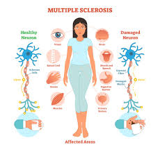 <p><strong>A 41-year-old woman was diagnosed with multiple sclerosis (MS) 7 years ago and is sharing her story with members of an MS support group, many of whom have been diagnosed recently. Which of the following aspects of her health problem should the woman warn others to expect at some point in the progression of the disease? Select all that apply.</strong></p><p>A) Debilitating fatigue</p><p>B) Progressive loss of visual acuity</p><p>C) Gradual development of a resting tremor</p><p>D) Loss of mental acuity</p><p>E) Shuffling gait </p>