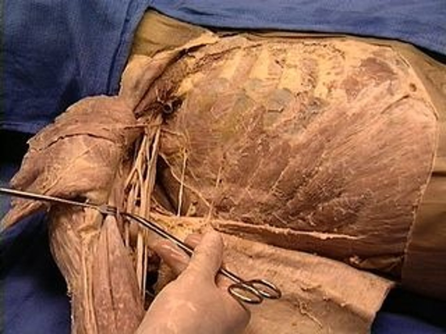 <p>ACTION -FLEXION AND ADDUCTION OF THE HUMERUS; SYNERGIST OF PECTORALIS MAJOR</p>