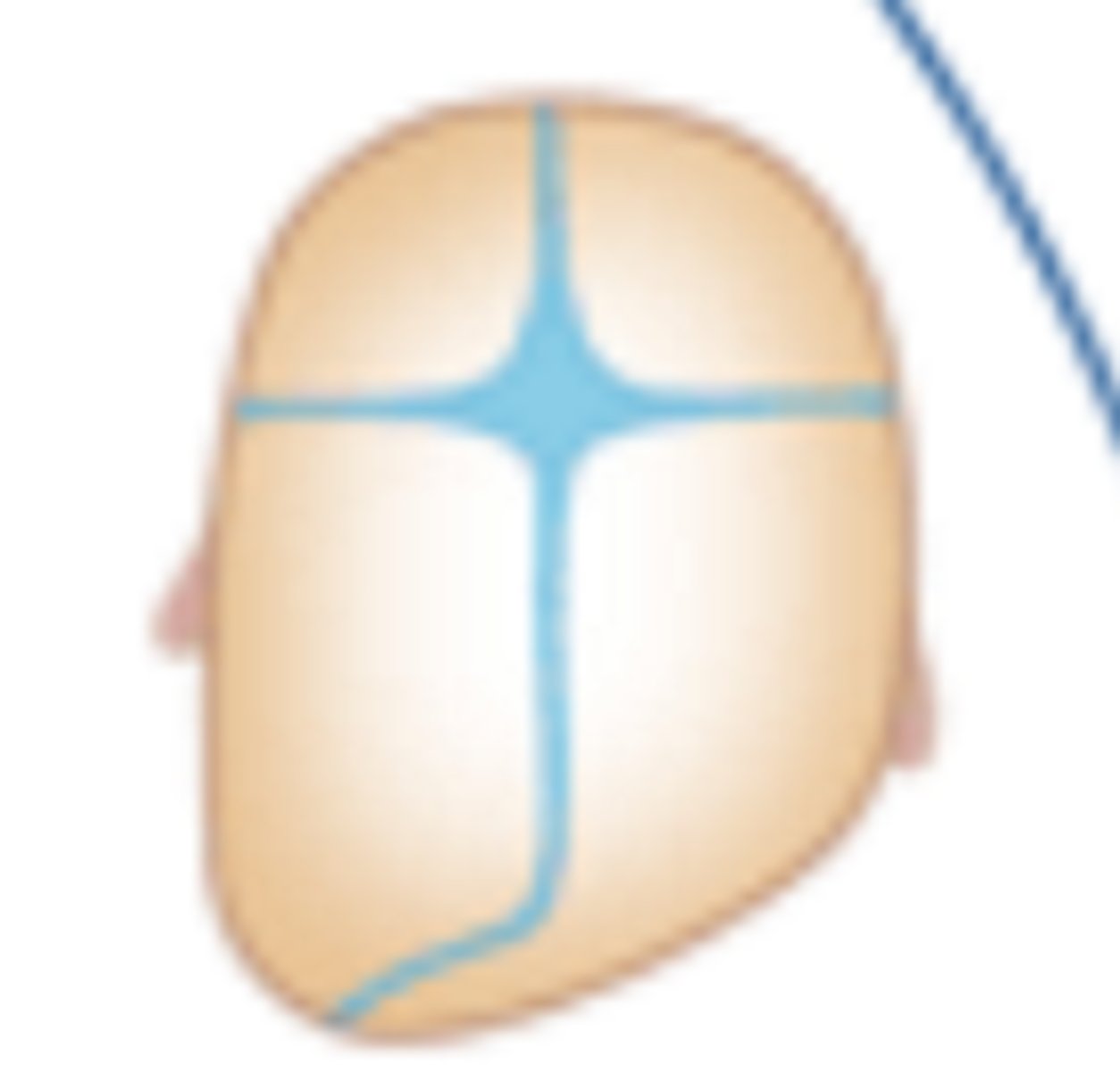 <p>lamboid synostosis</p>