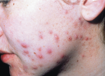 Causative agent is Cutibacterium (Propionibacterium) acnes 

* Gram-positive anaerobe 
* Mild/moderate cases treated with topical salicylic acid or benzoyl peroxide 
  * Benzoyl peroxide is available combined with the antibiotics clindamycin (Benzaclin) or erythromycin (Benzamycin) 
* Severe cases treated with isotretinoin (Accutane) 
  * Isotretinoin must not be given to pregnant women because it is a potent teratogen (causes birth defects in a developing fetus aka death of fetus) 