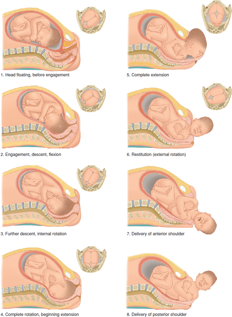 <ul><li><p>Engagement </p><ul><li><p>When widest diameter of fetal presenting part has passed through pelvic inlet </p></li><li><p>In most, the bony presenting part is at level of the maternal ischial spines when head becomes engaged </p></li></ul></li><li><p>Descent </p></li><li><p>Flexion of head </p><ul><li><p>Partial flexion exists before labor → further flexion occurs with descent </p></li></ul></li><li><p>Internal rotation </p></li><li><p>Extension </p></li><li><p>External rotation </p></li><li><p>Expulsion </p></li></ul><p></p><p></p>