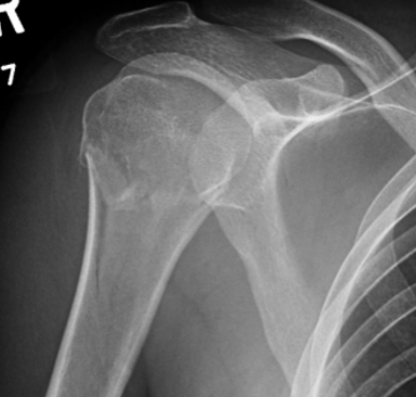 <p>types of humeral fractures</p>