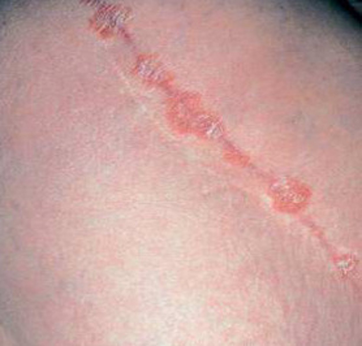 <p>linear lichen planus</p>