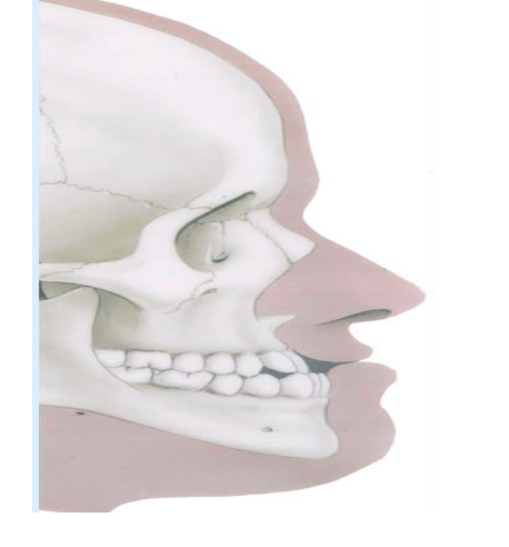<ul><li><p><span style="background-color: transparent;">it is prognathic&nbsp;</span></p><ul><li><p><span style="background-color: transparent;">A malocclusion&nbsp;</span></p></li><li><p><span style="background-color: transparent;">Skeletally and Dentally pronathic ( underbite)&nbsp;</span></p></li><li><p>the lower 1st molar is in front of the upper 1st molar; lower canine<span style="background-color: transparent;"> is also infront of upper</span></p></li></ul></li></ul><p></p>