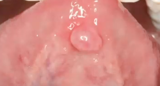 <p>mucocele on ventral tongue </p>
