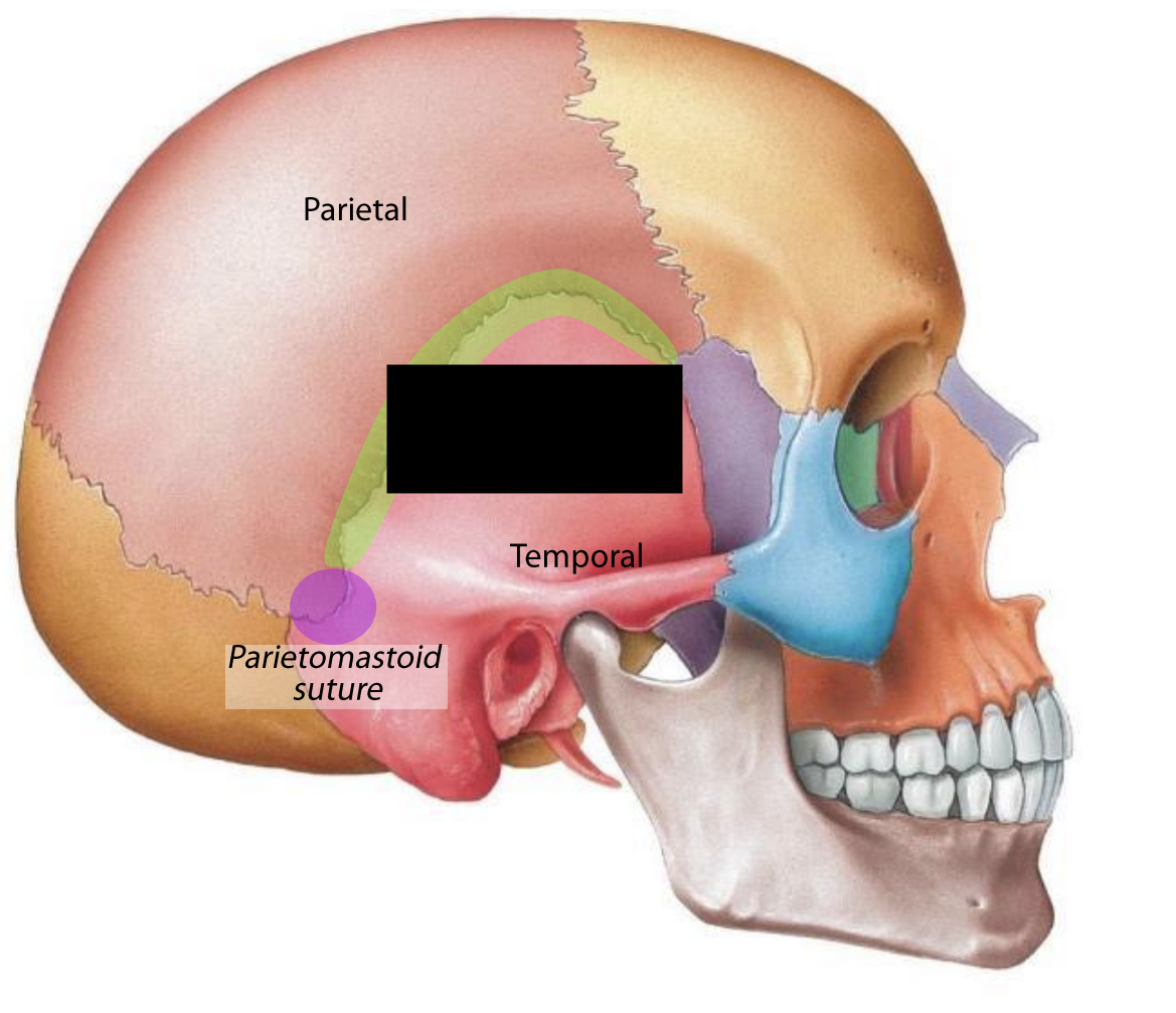 What suture is this?