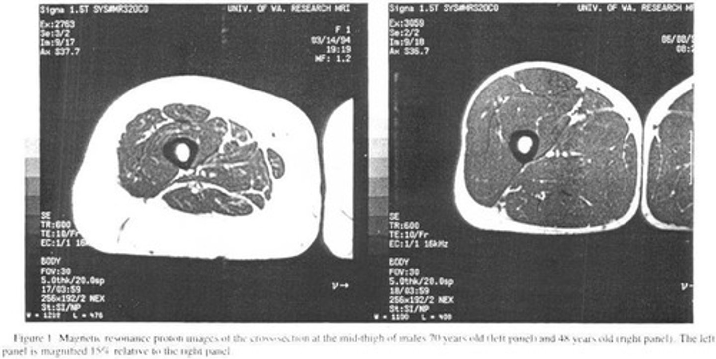 <p>Loss of skeletal muscle and strength associated with aging, with a loss of 0.5-1% per year after age 25.</p>