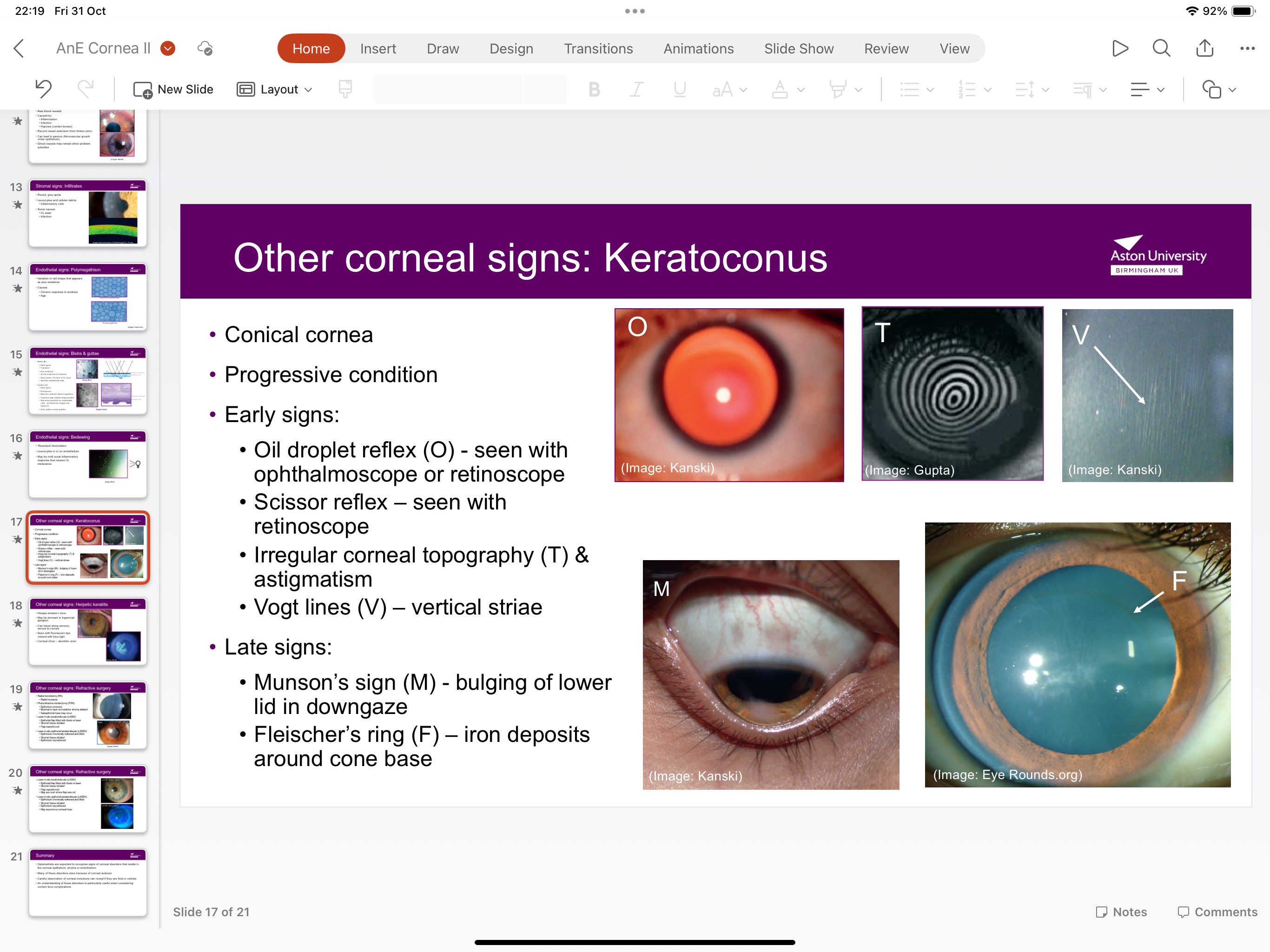 <p>Conical cornea- early signs include irregular astigmatism, scissor reflex and Vogt lines</p><p>Late signs involve bulging of lower lid iron deposits around cone base</p>