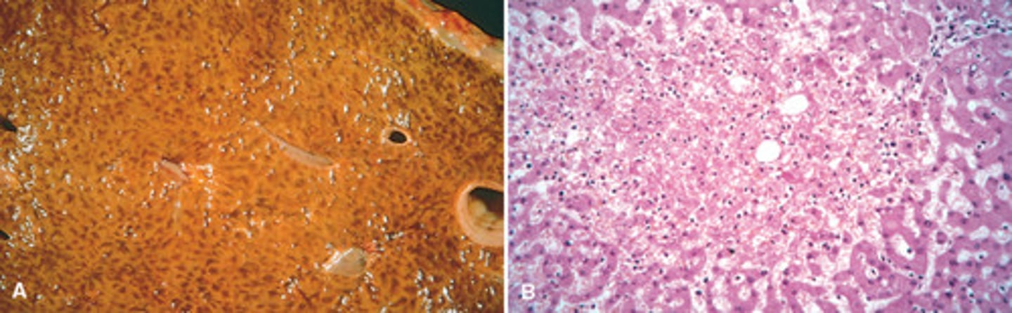 <p>damage to liver vessels leads to mixing of extravasated RBCs with pale areas of the liver (necrotic cells)</p>