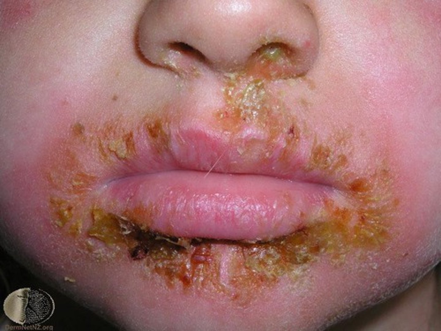 <p>Dried Exudate &gt; fluid from tissue (impetigo)</p>