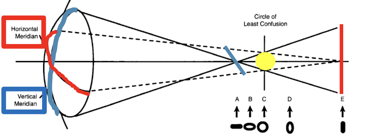 <p><br>Rays traveling through the vertical meridian (blue) will form a point first. Horizontal focal line is observed<br>Rays traveling through the horizontal meridian (red) will form a point after. Vertical line is observed<br><br>Because the refracting power is greatest in the vertical meridian — the horizontal focal line will be closer to the aperture of the optical system than the vertical focal line </p>