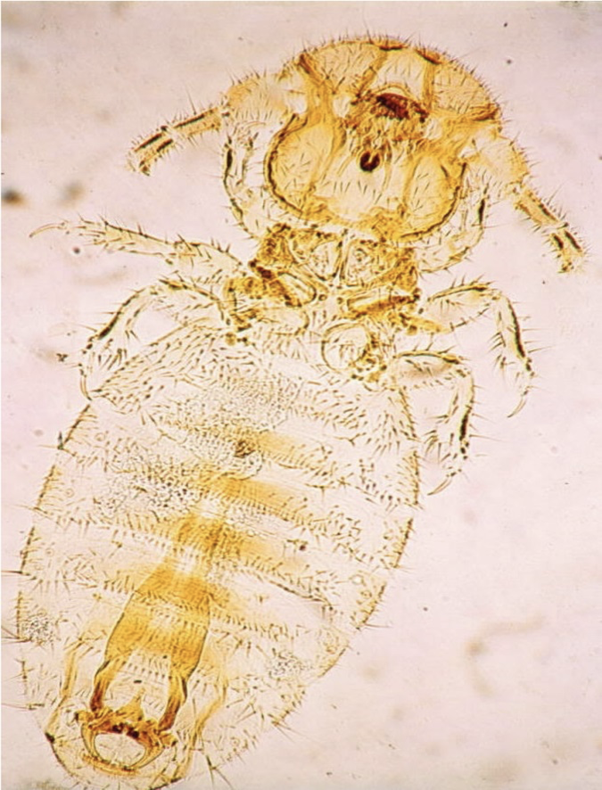 <p>Lice:</p><ul><li><p>1-2 mm long</p></li><li><p>6 legs, elongated abdomen</p></li><li><p>Definite rounded head (see image)</p></li></ul><p></p><p>Mites:</p><ul><li><p>0.7 mm long</p></li><li><p><strong>8 legs</strong>, rotund body, pointy head</p></li><li><p>Has a funnel-shaped sucker w/ long stalk&nbsp;</p></li><li><p>Look like round, white frogs&nbsp;</p></li></ul><p></p>