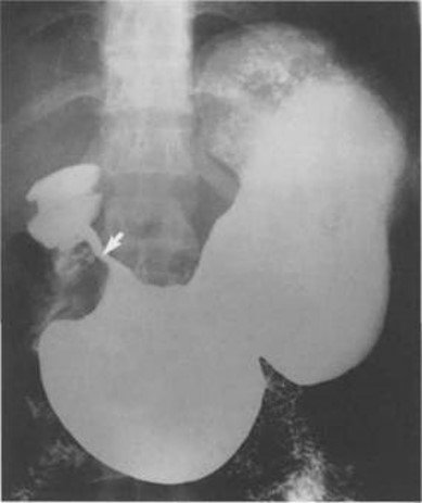 <p>Tumor</p>