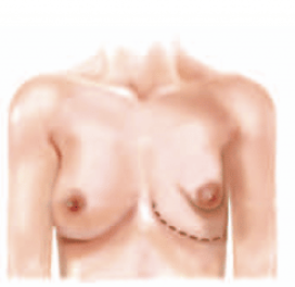 <p>Underdevelopment of lower medial and lateral quadrant of breast with skin deficiency in subareolor region</p>