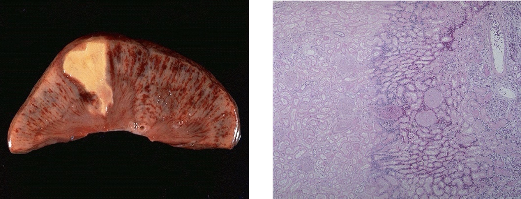 <p><span>You’re given with a kidney specimen:</span></p><p><span>1. Describe the gross lesion. <br>2. Describe the microscopic morphology? <br>3. What is the usual cause of such a condition? </span></p>