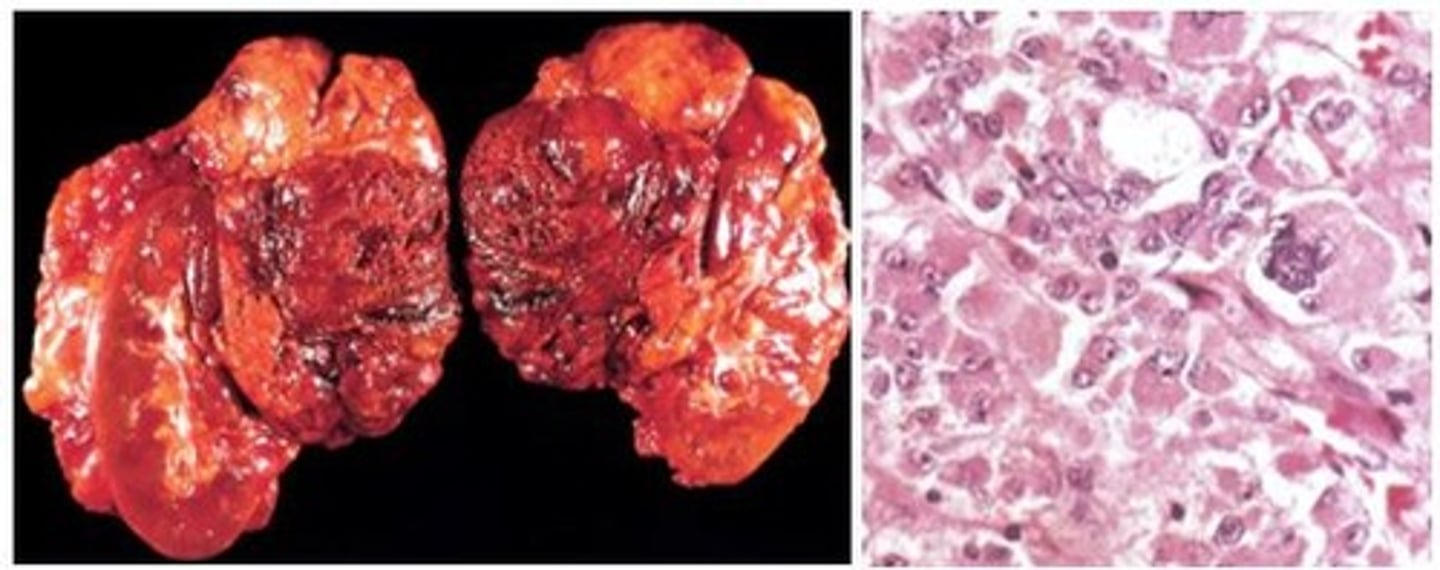 <p>Define Condition:</p><p>RARE &amp; MALIGNANT Epithelial tumor (1/2 are functional)</p><p>-Prog: SIZE (larger =&gt; worrisome); Overall poor prognosis with 5 year mortality 50 - 90%</p><p>-Tx: Surgical Resection</p>