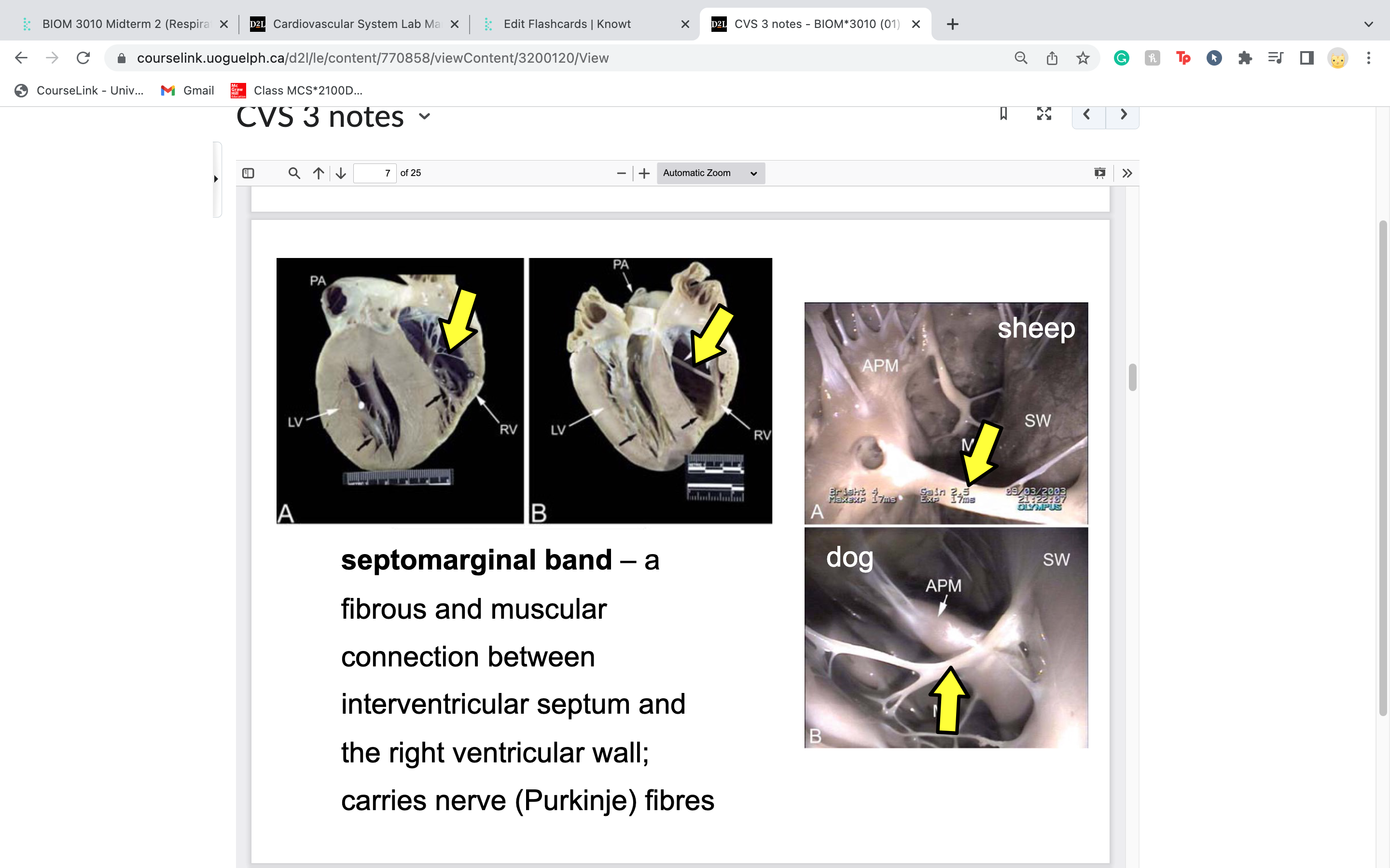  fibrous and muscular
connection between
interventricular septum and
the right ventricular wall;
carries nerve (Purkinje) fibres

only on right side!