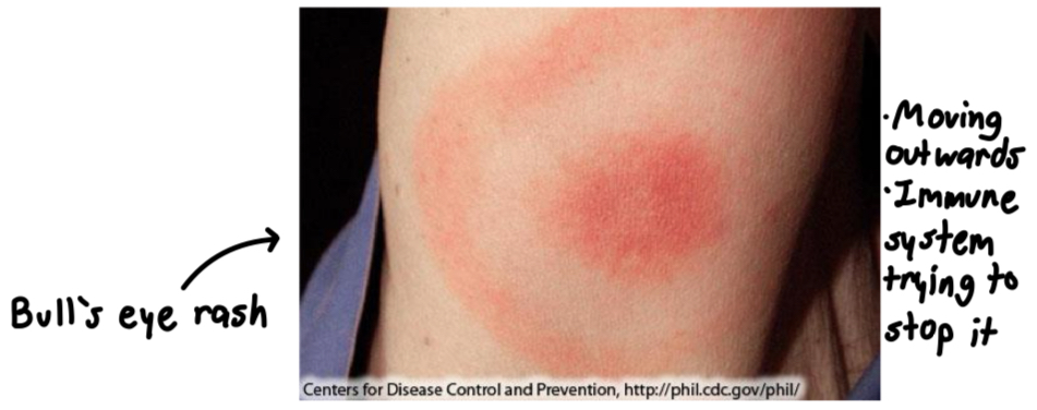 <p>Symptoms:</p><ul><li><p>First phase (days to first few weeks after transmission), severe headache, fever, fatigue, common but not always a bull’s eye rash (as bacteria spread in the skin)</p></li><li><p>Second phase (weeks to months), neurological issues – face paralysis (Bell’s palsy), arthritis, carditis (inflammation of the heart)</p></li><li><p>Third phase (months to years), arthritis especially in knees, tiredness, continued neurological issues</p></li></ul>