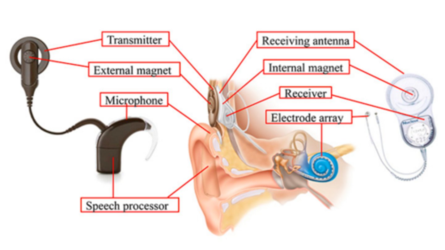 <p>Microphone</p><p>Speech processor</p><p>Transmitter</p><p>receiver/stimulator</p><p>Electrode array</p><p>Cochlea</p><p>Auditory nerve</p>