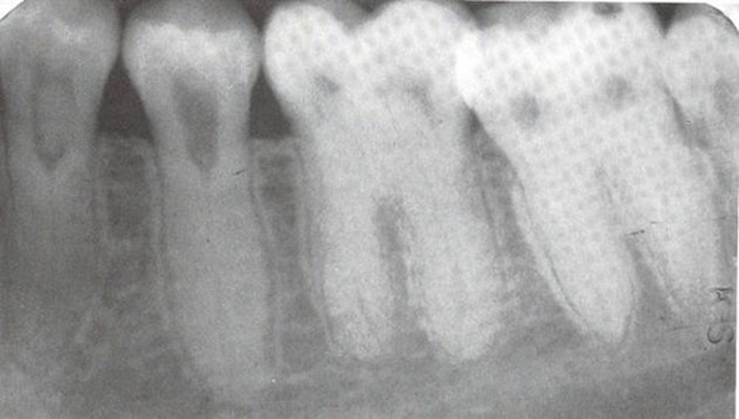 <p>Type 2 Coronal</p>
