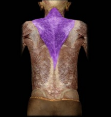 <p>Elevates, retracts, and depresses scapula; innervated by the Accessory Nerve.</p>
