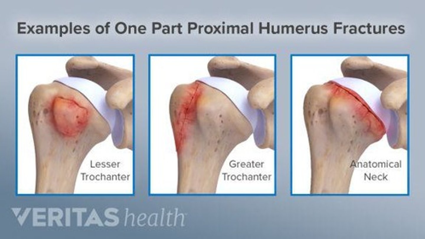 <p>Injury to the axillary nerve</p>