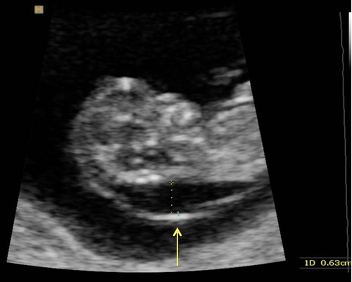 <p>Anechoic fluid area in posterior neck region</p><p>Associated with Trisomy 21</p><p>> 3.4 mm</p>