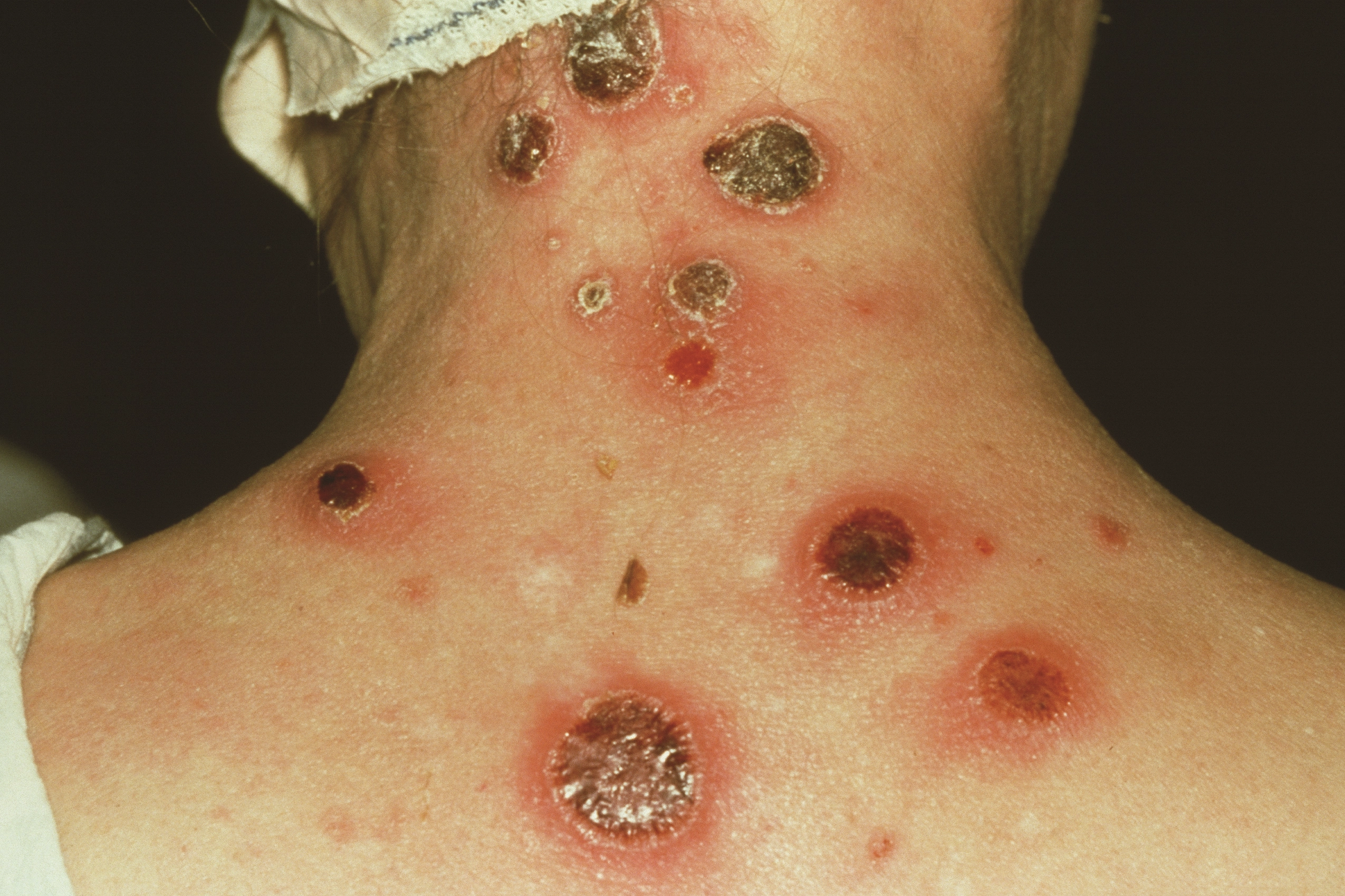 <p>cause : treponema palladium </p><p>stages and sympyoms : </p><ol><li><p>primary- painless chance % becomes systemic </p></li><li><p>secondary - rash on plam/soles </p></li><li><p>Latent - no symp, last years </p></li><li><p>Tertiary - most painful,fummas appear yrs later </p></li></ol><p>virulence factors </p><ul><li><p>hyaluronidase </p></li><li><p>antigenic variation</p><p>can be congential and cause neurological damage in baby  </p></li></ul><p>some strains cause YAWS </p><p></p>