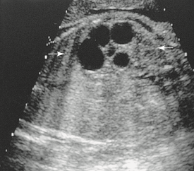 <p><span><span>An oblique sonogram of the fetal abdomen most likely demonstrates:<br></span></span></p>