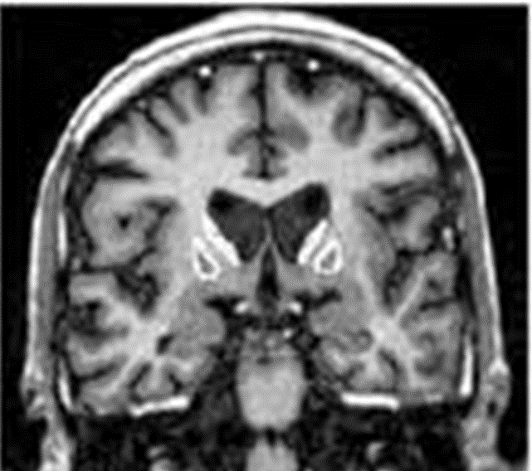 <p>atrophy of cerebral cortex & caudate nucleus </p>