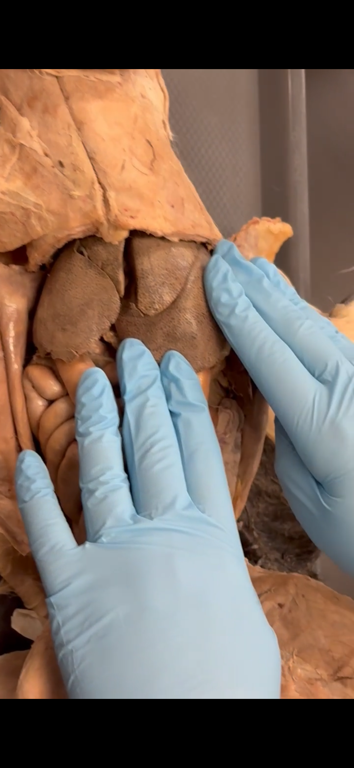 <p>Both hands are touching which lobe</p>