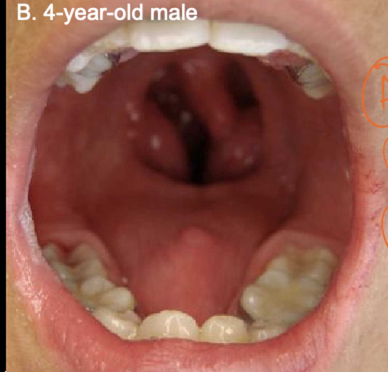 <p>absence of a tongue</p>