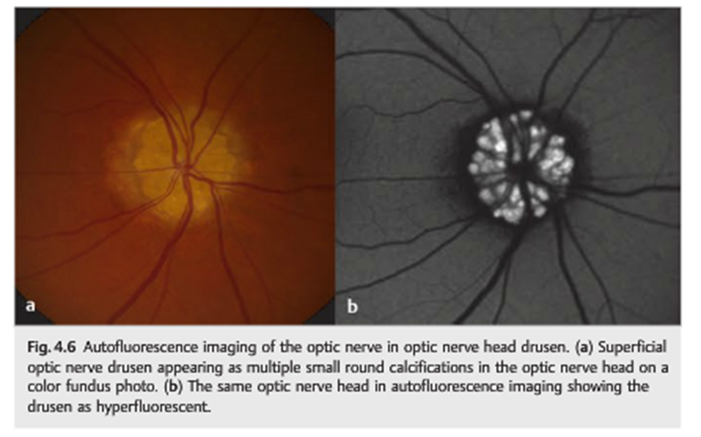 <ul><li><p><span>Only </span><strong><span>superficial/overt</span></strong><span> calcified drusen will </span><strong><span>hyperautofluoresce</span></strong></p><ul><li><p><span>If too deep, you will not be able to view on FAF</span></p></li></ul></li></ul>