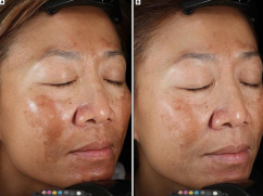 <p><strong>Melasma Treatment</strong></p><p>-No _________ therapy, tough to treat due to recurrence rate</p><p>-Therapies that target photo-damage, inflammation, aberrant vascularity, and abnormal pigmentation provide best outcomes </p><p>-_____________ is key: avoid the sun, wear UV protection</p><p>-Mild melasma can be treated with _____________ 4% cream or BID x 2-4 months</p><p>-Moderate to Severe melasma can be treated with triple _________ cream, flucinolone acetonide + hydroquinone + tretinoin</p>