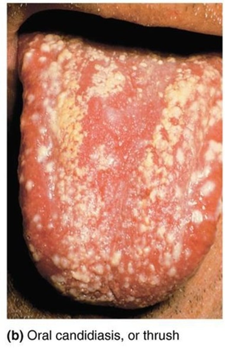 <p>Overgrowth of Candida albicans (yeast); Forms pseudohyphae, making it resistant to phagocytosis</p><p>Results when antibiotics suppress competing bacteria or a change occurs in the mucosal pH</p>