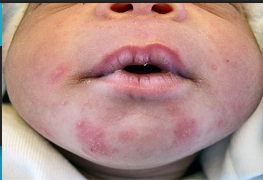 <p><strong>Erythema Toxicum Neonatorum </strong></p><p>-Common newborn rash → most common in _______ birthweight or greater gestational age infants </p><p>-Appears within the first __ hours of life </p><p>-Multiple ____________ macules and papules → progress to _________ on an erythematous base, most commonly on the _____ and proximal extremities </p><p>-Spontaneously resolves within a ______, so no treatment is necessary </p>