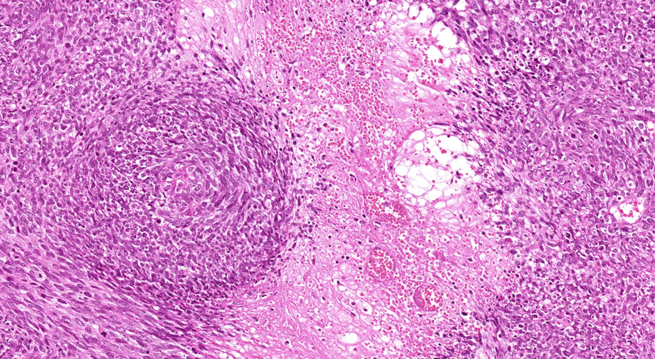 <p>Undifferentiated pleomorphic sarcoma, necrosis green and hemorrhage</p>