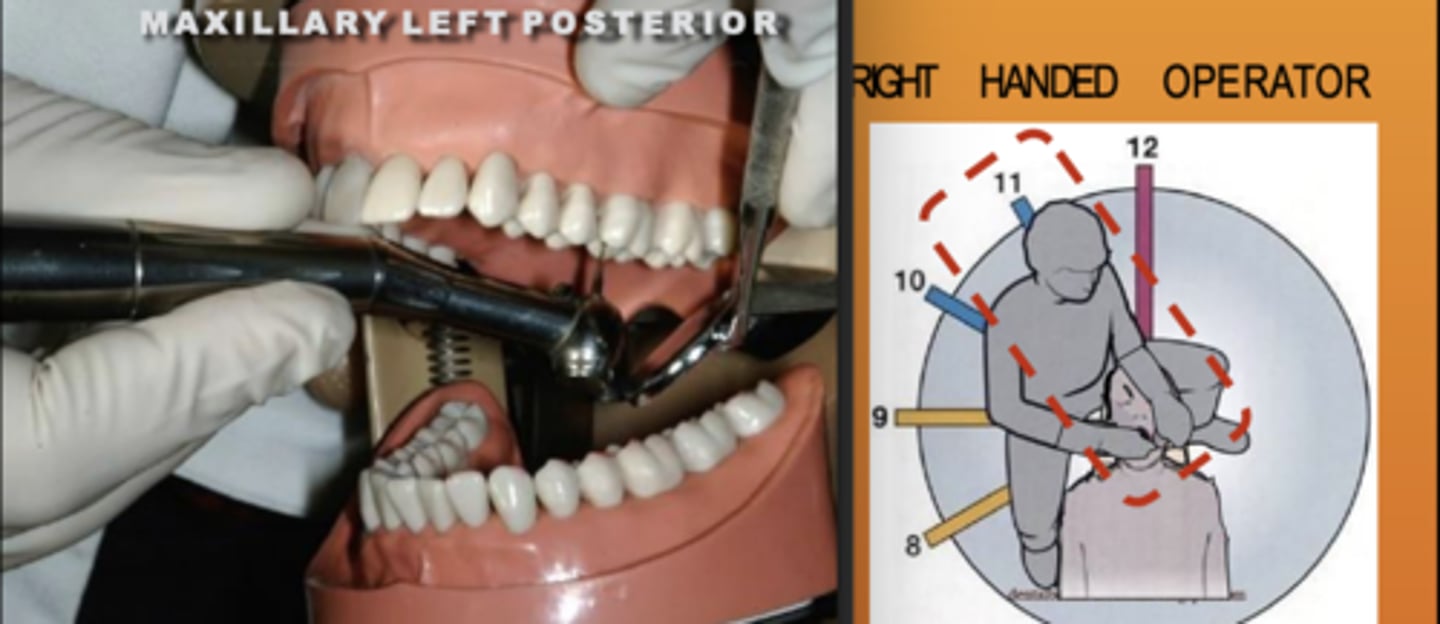 <p>Zone: 11</p><p>Vision: indirect</p><p>Patient's Head: Center</p><p>Fulcrum: Max Right Premolar</p>