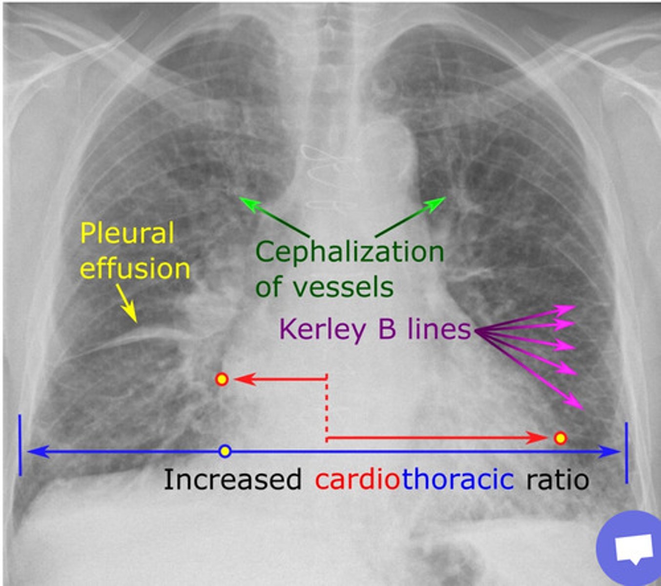 <p>1. Pleural effusion<br>2. Dilated pulmonary arteries <br>3. Kerley B lines <br>4. Bat's wings <br>5. Cardiomegaly</p>