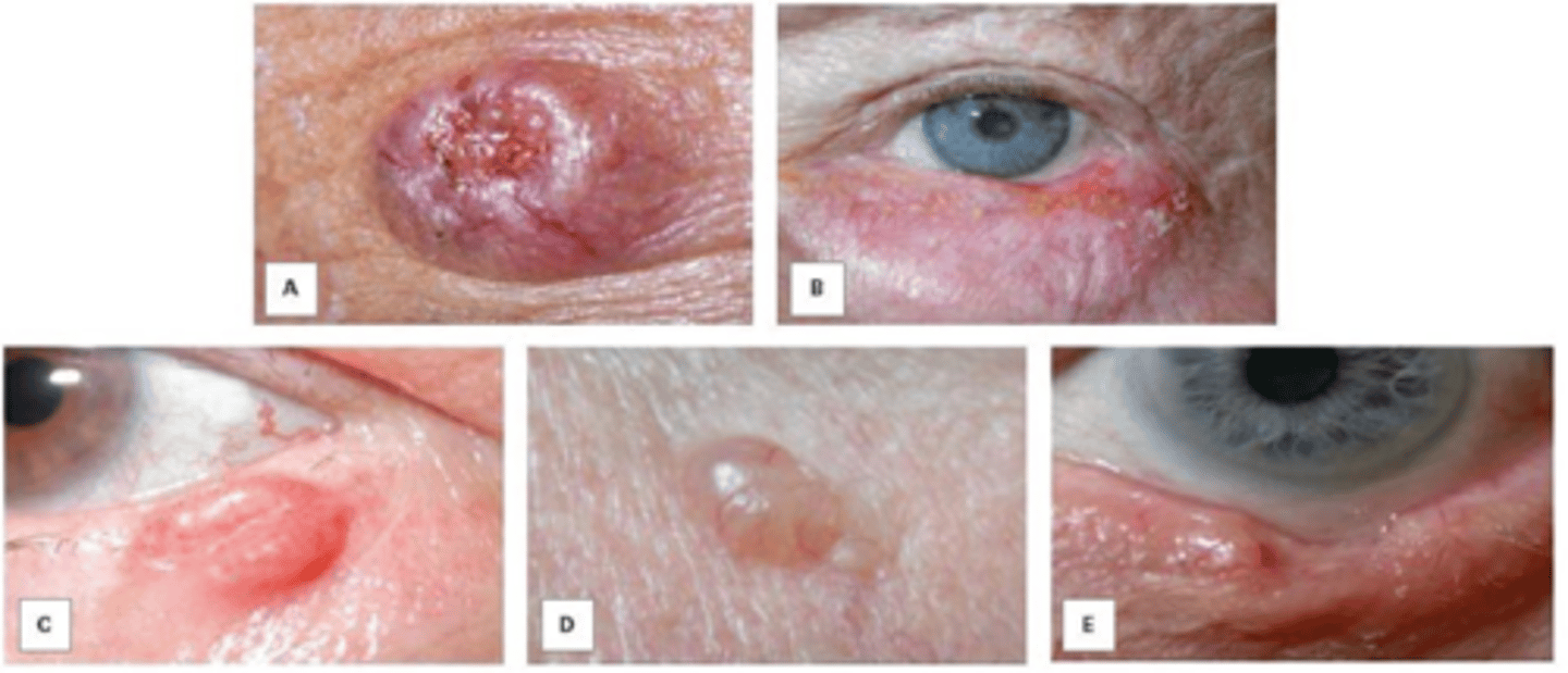 <p>Asymmetry = ulceration</p><p>Borders = irregular</p><p>Colour = variation, telangiectasia, pearly</p><p>Diameter and size</p><p>Evolving = loss of eyelid architecture, etc.</p>