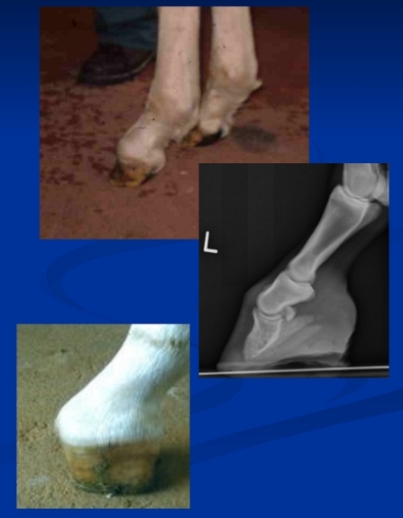 <p><span style="background-color: transparent;"><span>Club foot </span></span></p>