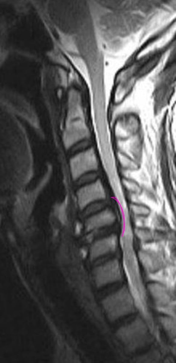 <p>What will cause the cord herniation</p>