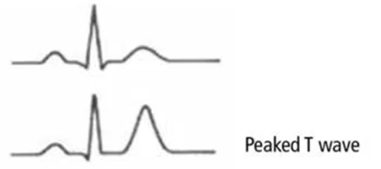 <ul><li><p>tall peaked T waves</p></li><li><p>muscle twitching/cramps (early)</p></li><li><p>weakness/paralysis (late)</p></li></ul><p></p>