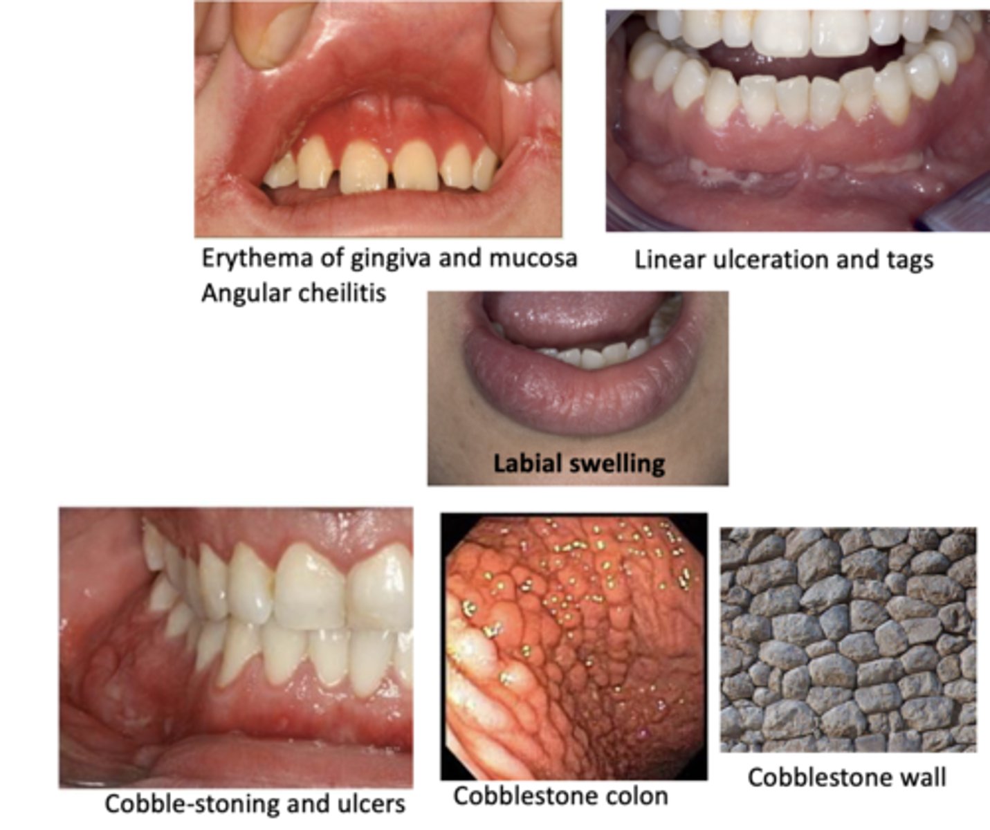 <p>Oral manifestations of this disease include:</p><p>• Cobble-stone appearance</p><p>• Linear ulceration</p><p>• Mucosal tags</p><p>• Mucositis and gingivitis</p><p>• Labial and facial swelling</p><p>• Angular cheilitis</p><p>• Aphthous ulcers</p>