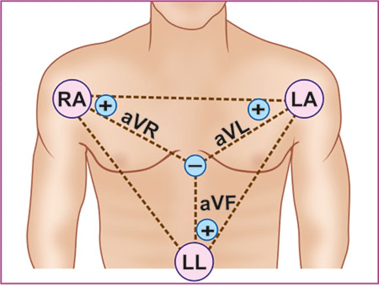 <p>one physical lead on pt, one theoretical neg pole in center of heart (Wilsons terminal)</p><p>aVL, aVR, aVF</p>